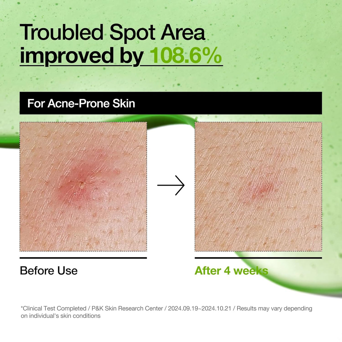 Anua 10+ Azelaic Acid Hyaluron Soothing Serum (30mL) - NeYavi